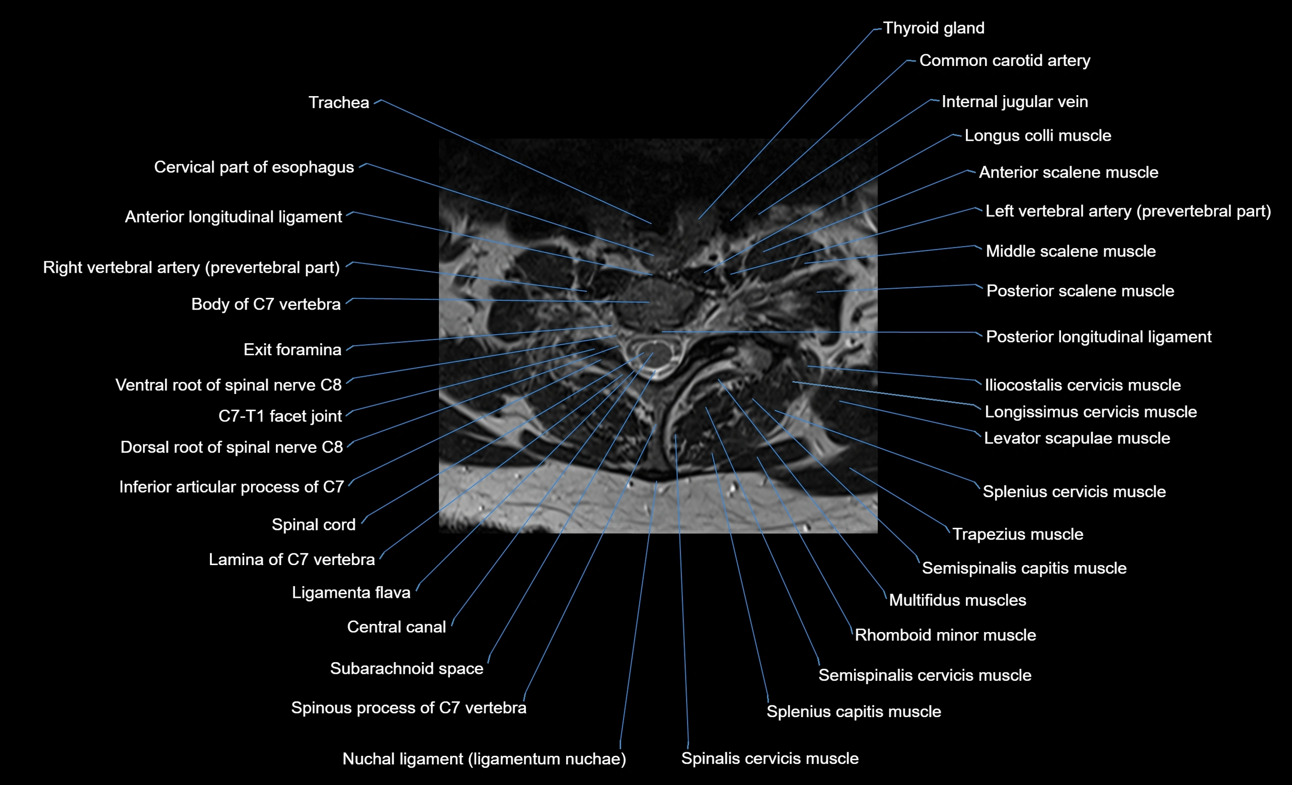 cervical spine cross sectional MRI anatomy  3T MRI axial  image-img-00001-00037.webp